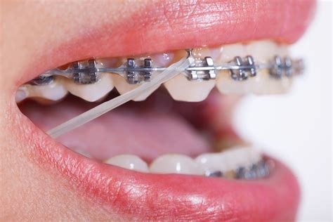 underbite metal bracket rubber bands not braces|rubber bands invisalign braces.